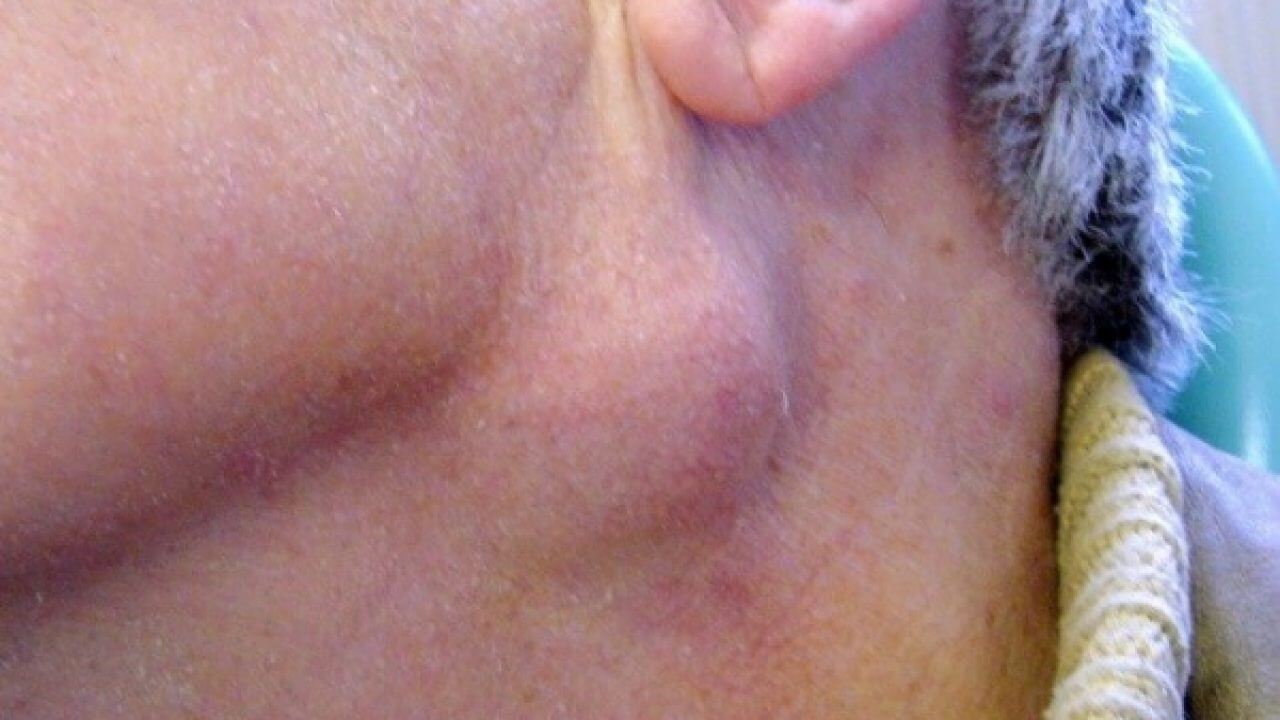 Nguyên nhân và cách phát hiện bệnh ung thư vòm họng 2