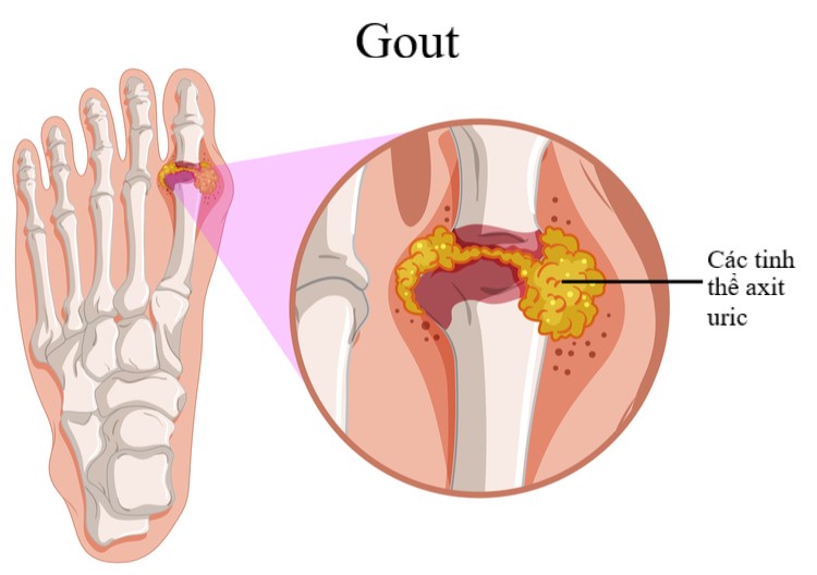 Bệnh gout (gút): Nguyên nhân và cách điều trị 1