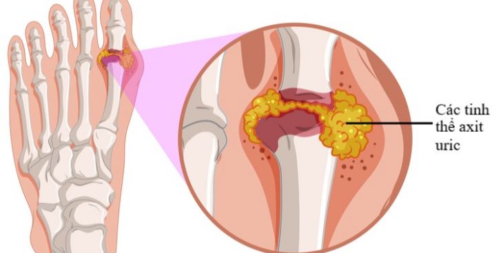 Bệnh gout (gút): Nguyên nhân và cách điều trị