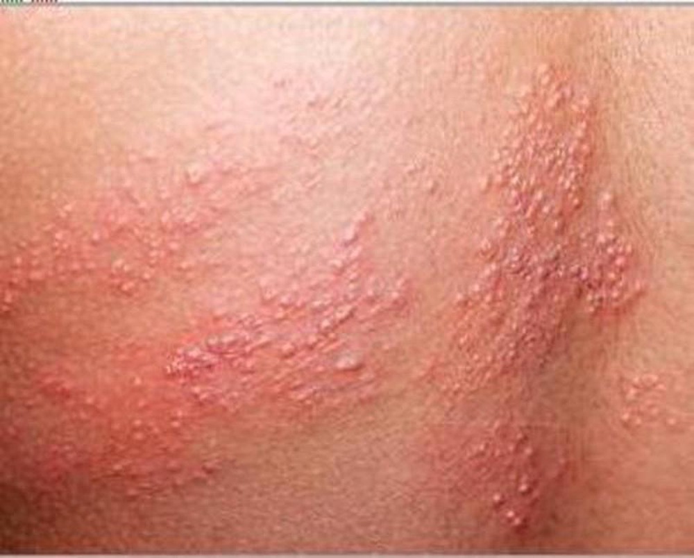 Bệnh zona thần kinh là bệnh gì? 3