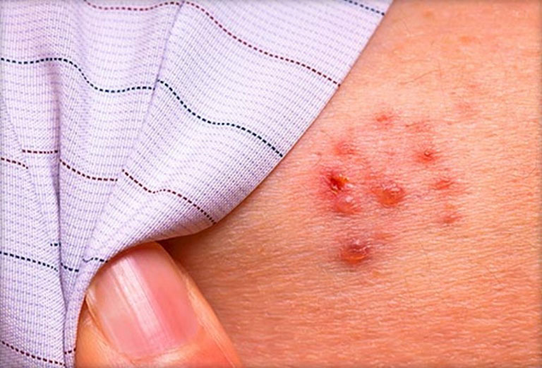 Bệnh zona có tự khỏi không? 1
