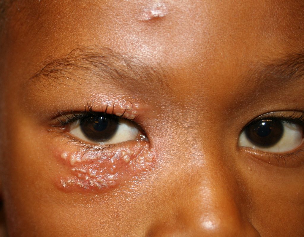 Bệnh zona thần kinh có nguy hiểm không? 2