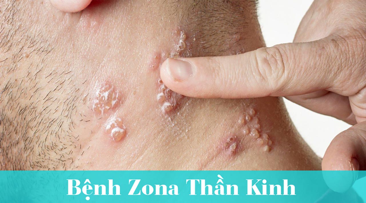 Nguyên nhân gây bệnh zona thần kinh (bệnh giời leo) 1