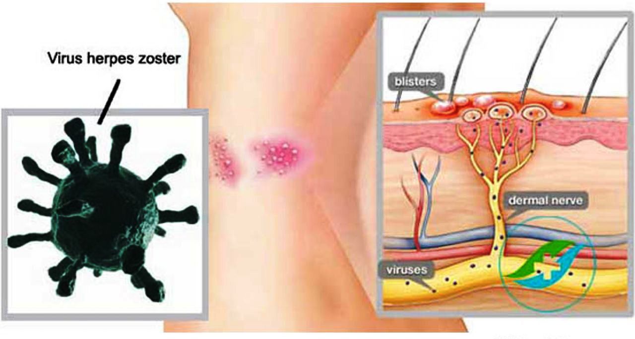 Nguyên nhân gây bệnh zona thần kinh (bệnh giời leo) 2