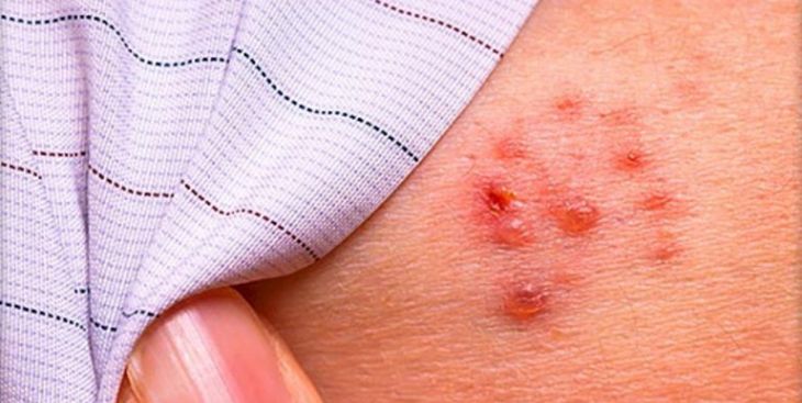 Bệnh zona có tự khỏi không? Bao lâu thì khỏi?