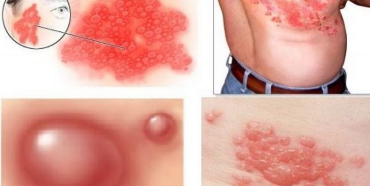 Bệnh zona thần kinh có nguy hiểm không?