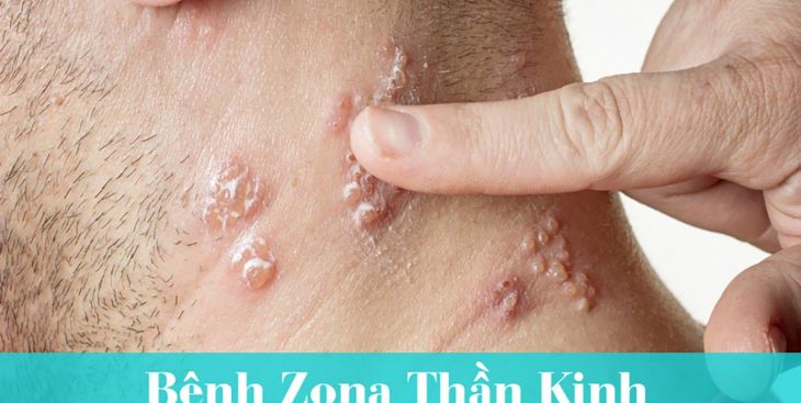 Nguyên nhân gây bệnh zona thần kinh (bệnh giời leo)