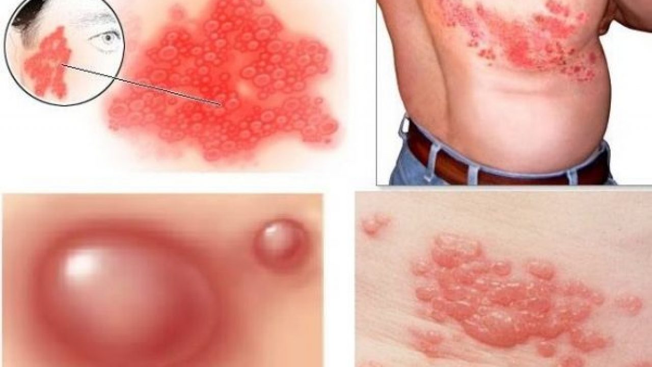 Triệu chứng, biểu hiện của bệnh zona thần kinh 1