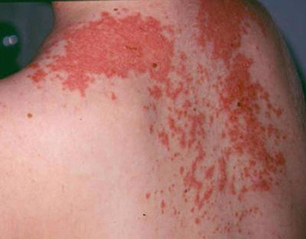 Triệu chứng, biểu hiện của bệnh zona thần kinh 3