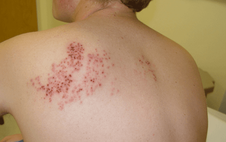 Cách chữa zona bằng nha đam đơn giản tại nhà 1