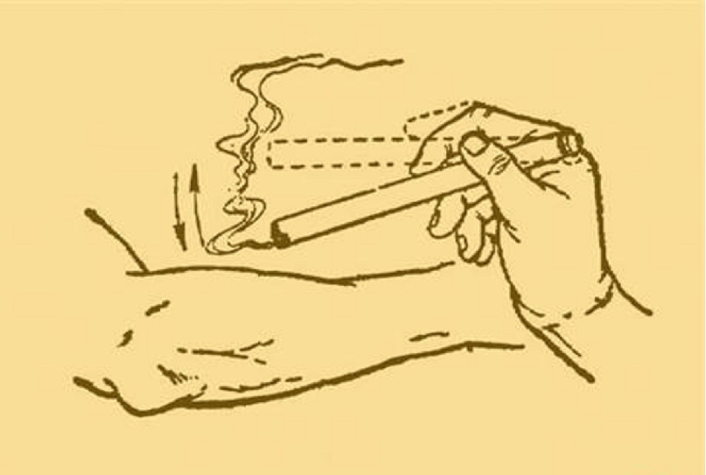 Cách chữa zona thần kinh bằng diện chẩn 2