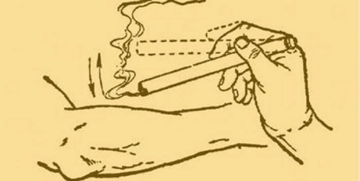 Cách chữa zona thần kinh bằng diện chẩn