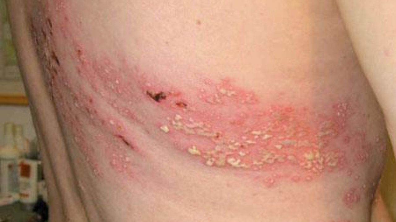 Cách giảm đau khi bị zona thần kinh 1