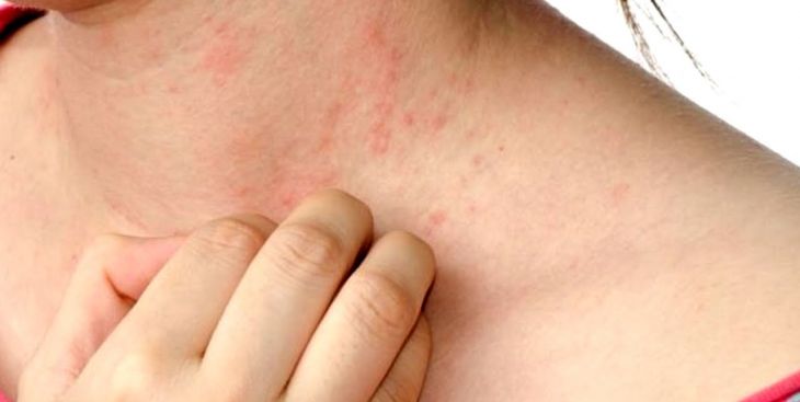 Cách giảm ngứa khi bị zona: làm thế nào hiệu quả?