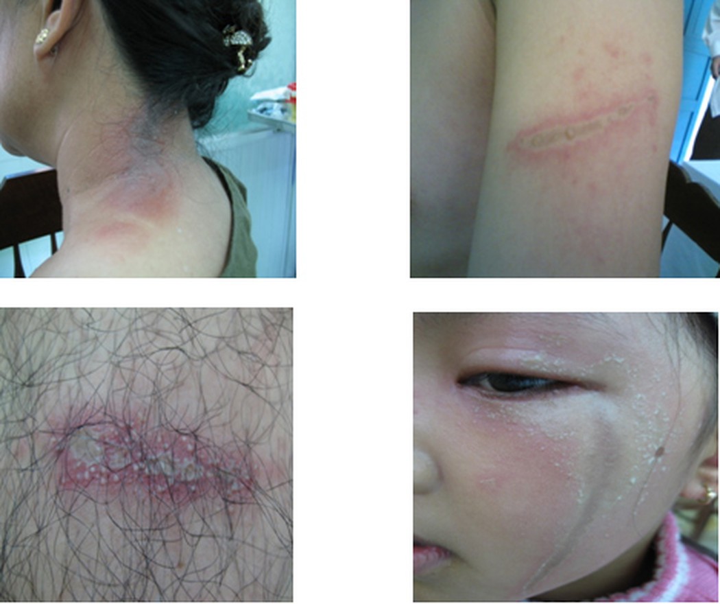 Trị vết thâm sau zona, lấy lại sự tự tin cho người bệnh 1