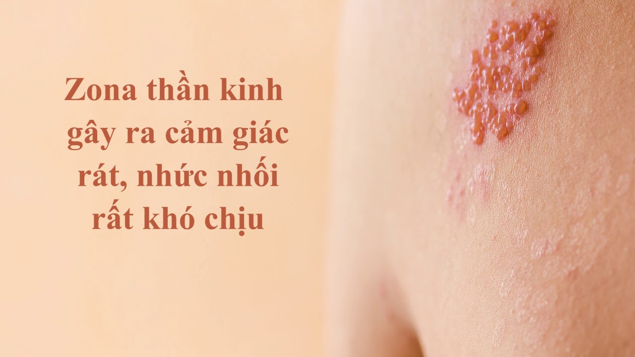 Các cách chữa zona thần kinh dân gian hữu hiệu 1