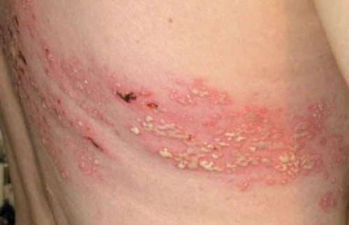 Bệnh zona chữa khỏi bằng nhiều phương pháp khác nhau