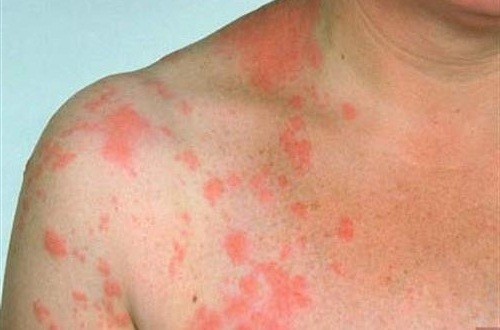  Một số biến chứng khác của bệnh zona