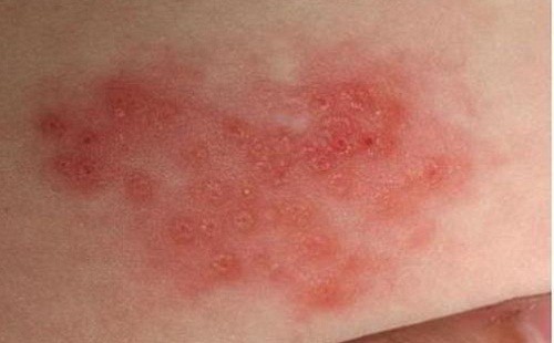 Bị zona ở mũi gây đau rát khó chịu cho người bệnh