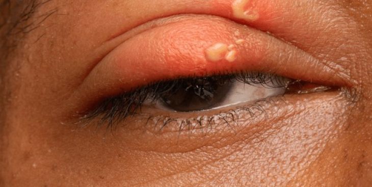 Zona thần kinh ở mắt: Nguyên nhân, triệu chứng và cách điều trị