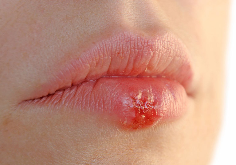 Zona ở môi do virus gây bệnh thủy đậu gây ra
