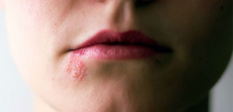 Zona thần kinh ở mặt do virus herpes gây ra