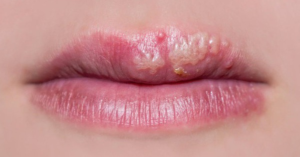 Người bệnh xuất hiện những mụn nước gây đau rát