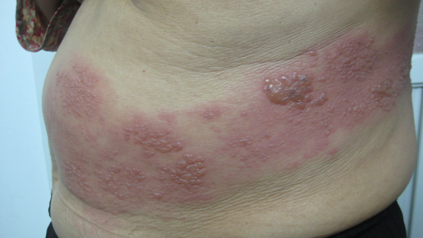  Hình ảnh bệnh zona ở bụng