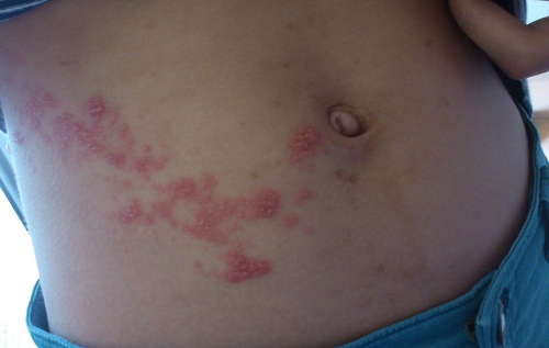 Bệnh zona ở bụng xuất hiện những mụn nước thành từng mảng