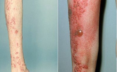 Hình ảnh bệnh zona ở chân