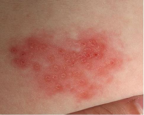 Bệnh zona ở chân xuất hiện những mụn nước đau rát