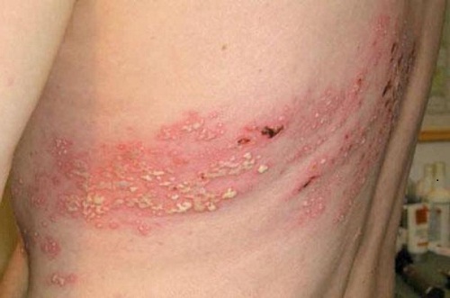 Hình ảnh bệnh zona ở lưng