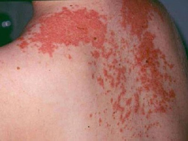 Bệnh để lâu thường lan sang những vùng da khác