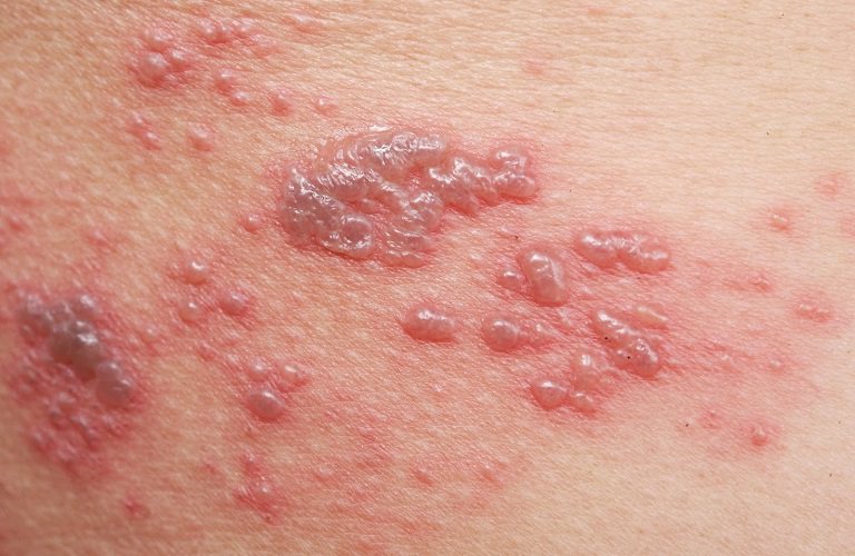 Zona thần kinh ở nách do virus gây bệnh thủy đậu gây ra