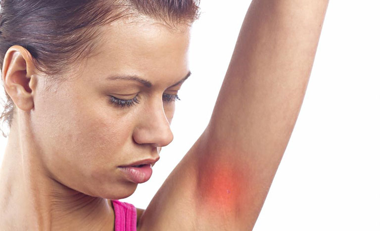 Bệnh xuất hiện ban đầu với vùng da ửng đỏ