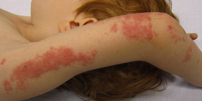 Hình ảnh bệnh zona ở tay