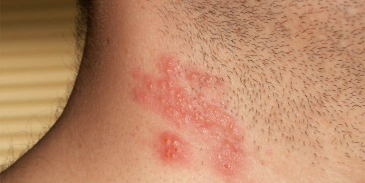 Bị zona ở cổ: Nguyên nhân, triệu chứng và cách chữa zona ở cổ