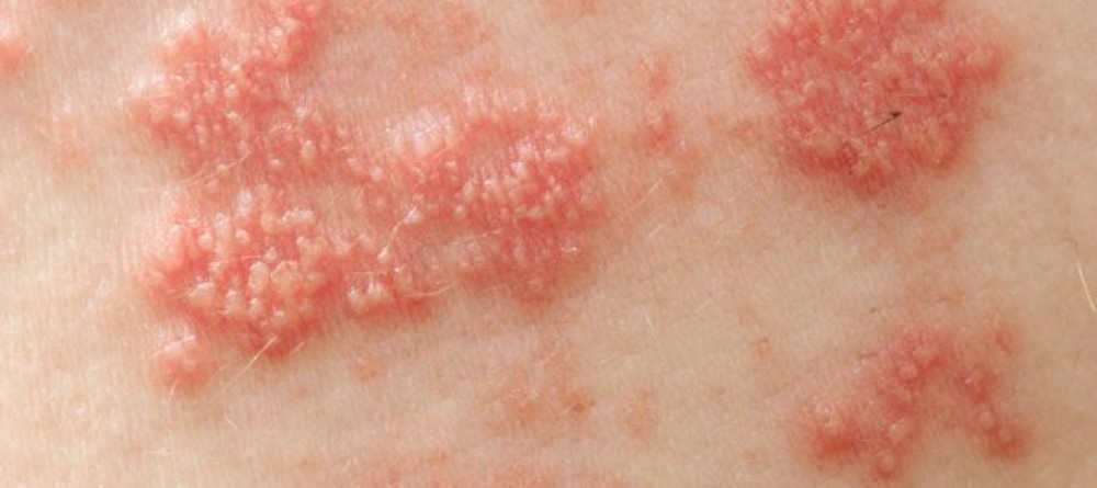 Zona tai do virus gây bệnh thủy đậu gây ra