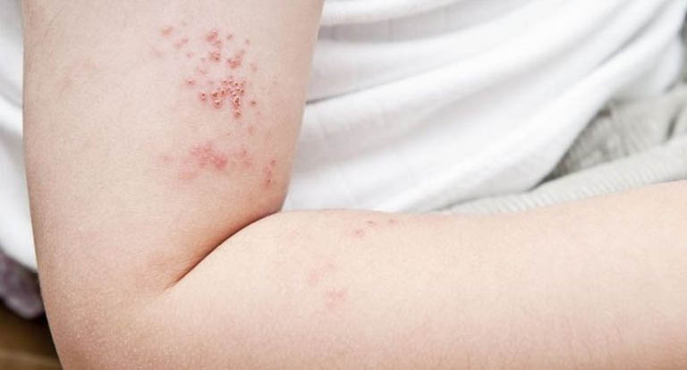 Dấu hiệu nhận biết bị zona thần kinh