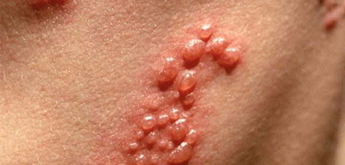 Bệnh zona gây cảm giác đau rát, khó chịu