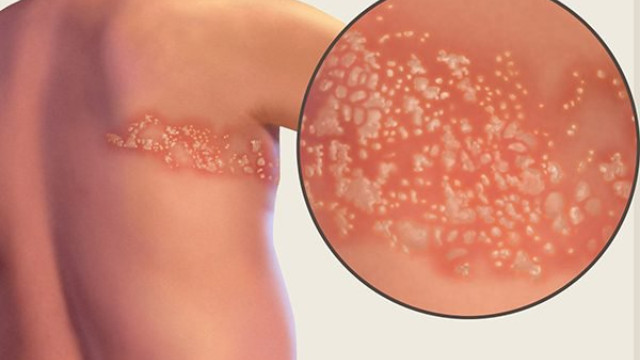 Hình ảnh bệnh zona