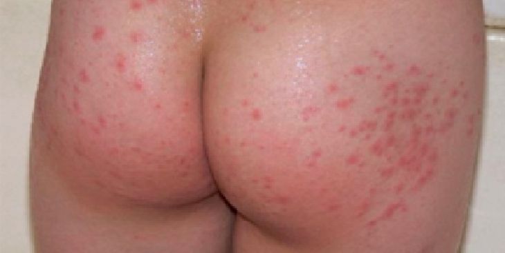 Bệnh zona ở mông cần kiêng những nhóm thực phẩm nào?