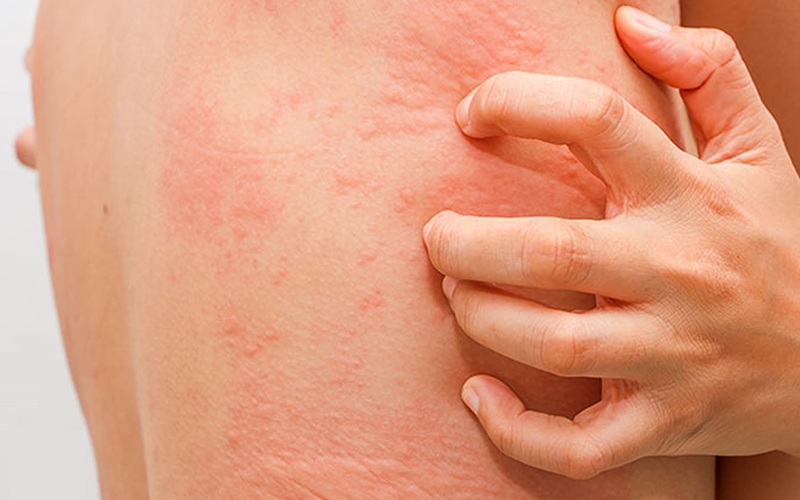 Những người dễ bị dị ứng không nên uống nước dừa thường xuyên