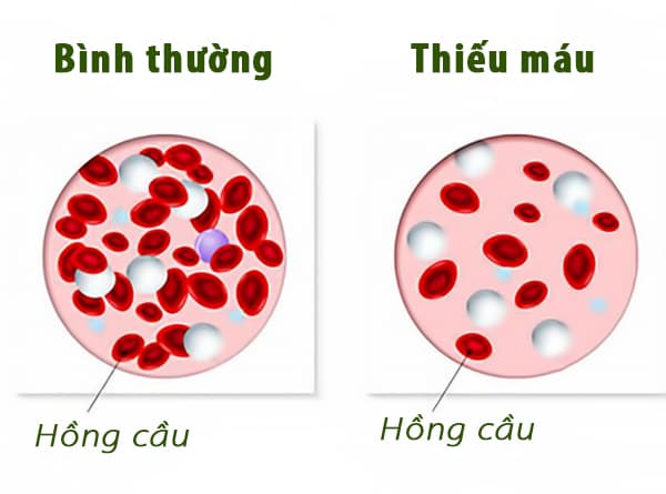 Hỗ trợ điều trị chứng thiếu máu