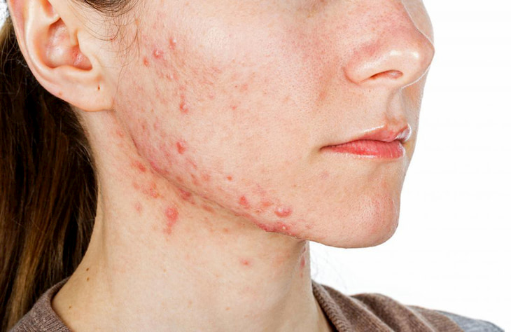 Mặt nạ nghệ điều trị mụn trứng cá